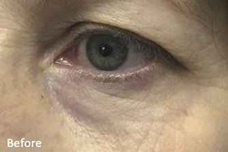 ACCUTITE & FACETITE before image