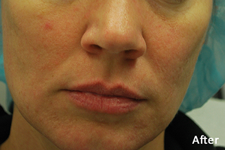 MORPHEUS8 BURST after image