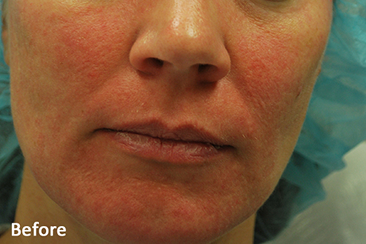 MORPHEUS8 BURST before image