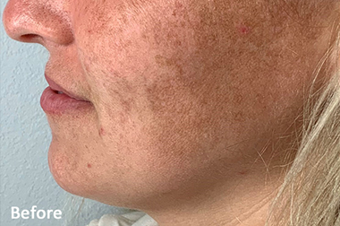 LUMECCA PEAK before image