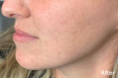 LUMECCA PEAK after image