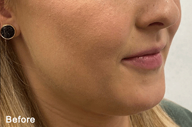 QUANTUMRF 10 before image