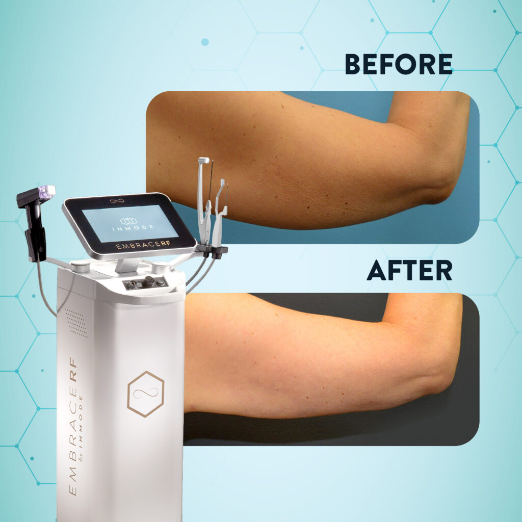 Optimas Max for Acne Scar Removal: Is It the Right Treatment for Your Scar Type?