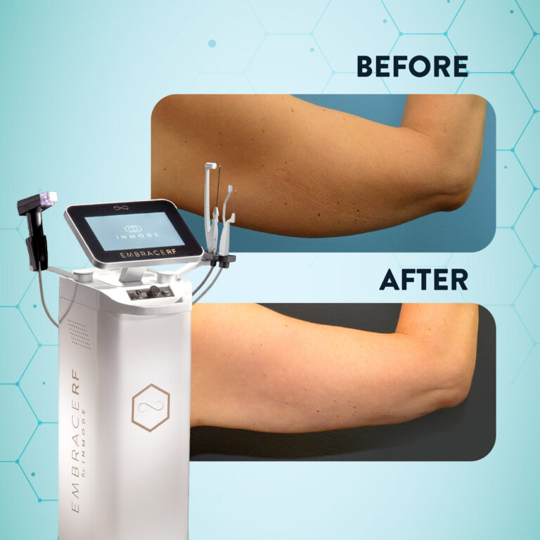 Optimas Max for Acne Scar Removal: Is It the Right Treatment for Your Scar Type?